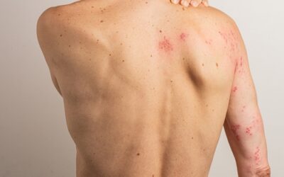 Shingles Vaccine: What You Need to Know — And Why It May Also Protect Your Brain